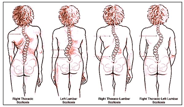 Csípő skoliozis kezelés, A gerincferdülés (scoliosis) fajtái - Súlypont Ízületklinika