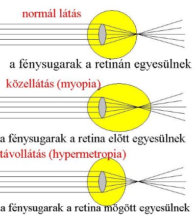 afferens látás oedema eye